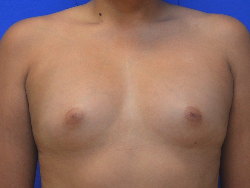 Surgery 400cc Breast Implants